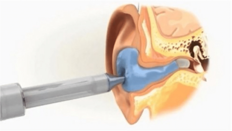 nettoyage auriculaire illustré par audition-passion à Villeneuve-sur-Lot avec injection de liquide bleu dans l’oreille